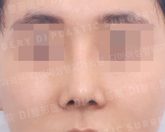 Own rib cartilage · Rhinoplasty · Short-nose correction · Dorsal hump correction · Front · After