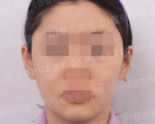 全脸 · 脂肪移植 · 正面 · 术前