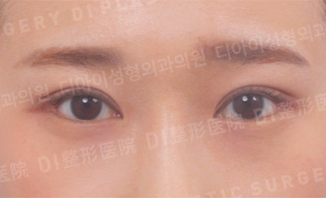 切開法によるまぶた修正 · 眼瞼下垂矯正 · 上目頭切開 · デュアル目尻切開 · 正面 · 術後