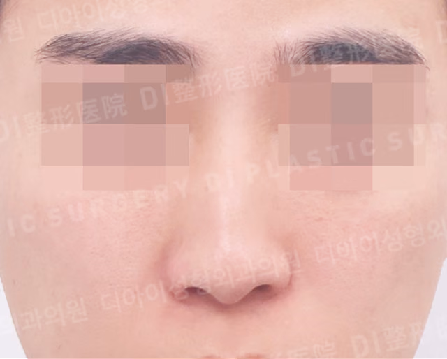 インプラントを使わない鼻形成術 · わし鼻修正 · 斜鼻修正 · 正面 · 術前