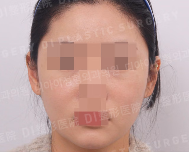 全脸 · 脂肪移植 · 正面 · 术后