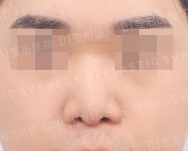 กระดูกอ่อนซี่โครงตนเอง · ศัลยกรรมแก้จมูก · แก้ไขจมูกสั้น · เสริมฐานข้างจมูก · ด้านหน้า · ก่อนทำ