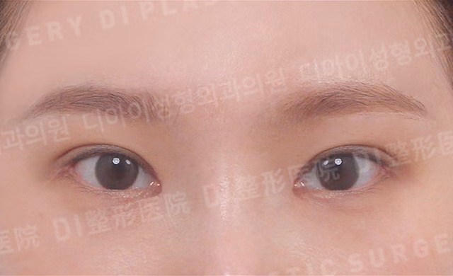切開法二重術 · 眼瞼下垂矯正 · 目頭切開 · デュアル目尻切開 · 正面 · 術後