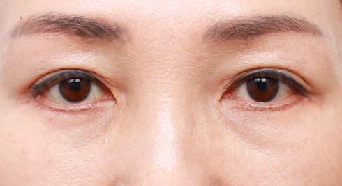 ศัลยกรรมเปลือกตาล่าง · ยกกระชับใต้คิ้ว · ด้านหน้า · หลังทำ