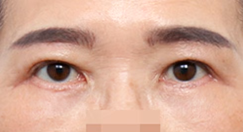ยกกระชับใต้คิ้ว · ศัลยกรรมเปลือกตาล่าง · ด้านหน้า · หลังทำ