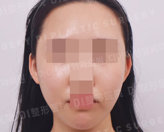 ลดโหนกแก้ม · ด้านหน้า · หลังทำ