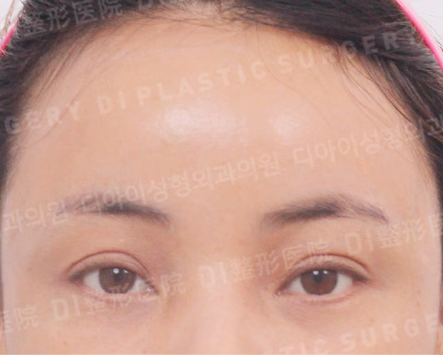額リフト · 正面 · 術後