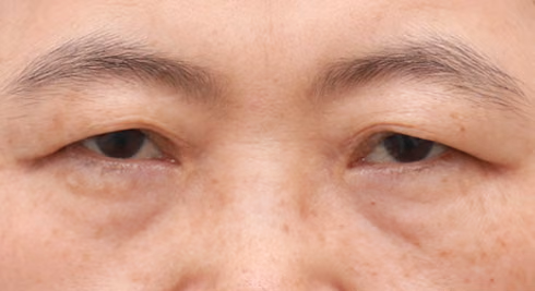 ยกกระชับใต้คิ้ว · ตาสองชั้นแบบไม่กรีด · ด้านหน้า · ก่อนทำ