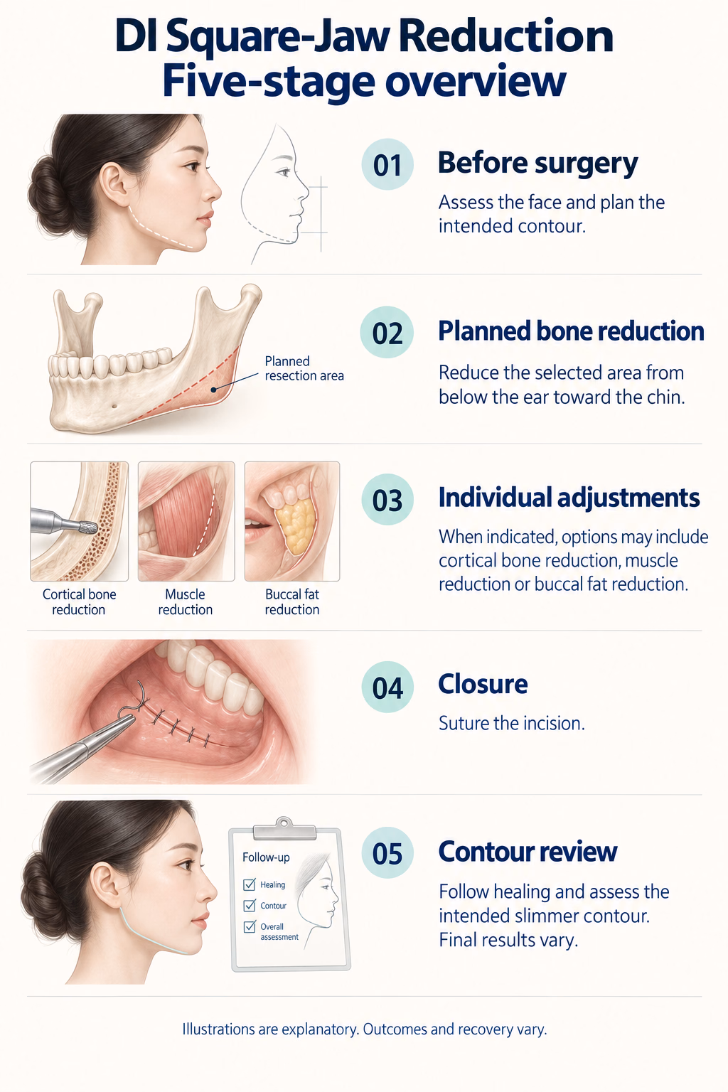 DI Square-Jaw Reduction
Five-stage overview
01  Before surgery
Assess the face and plan the intended contour.
02  Planned bone reduction
Reduce the selected area from below the ear toward the chin.
03  Individual adjustments
When indicated, options may include cortical bone reduction, muscle reduction or buccal fat reduction.
04  Closure
Suture the incision.
05  Contour review
Follow healing and assess the intended slimmer contour. Final results vary.
Diagram labels: Planned resection area; Cortical bone reduction; Muscle reduction; Buccal fat reduction; Follow-up: Healing, Contour, Overall assessment.
Illustrations are explanatory. Outcomes and recovery vary.