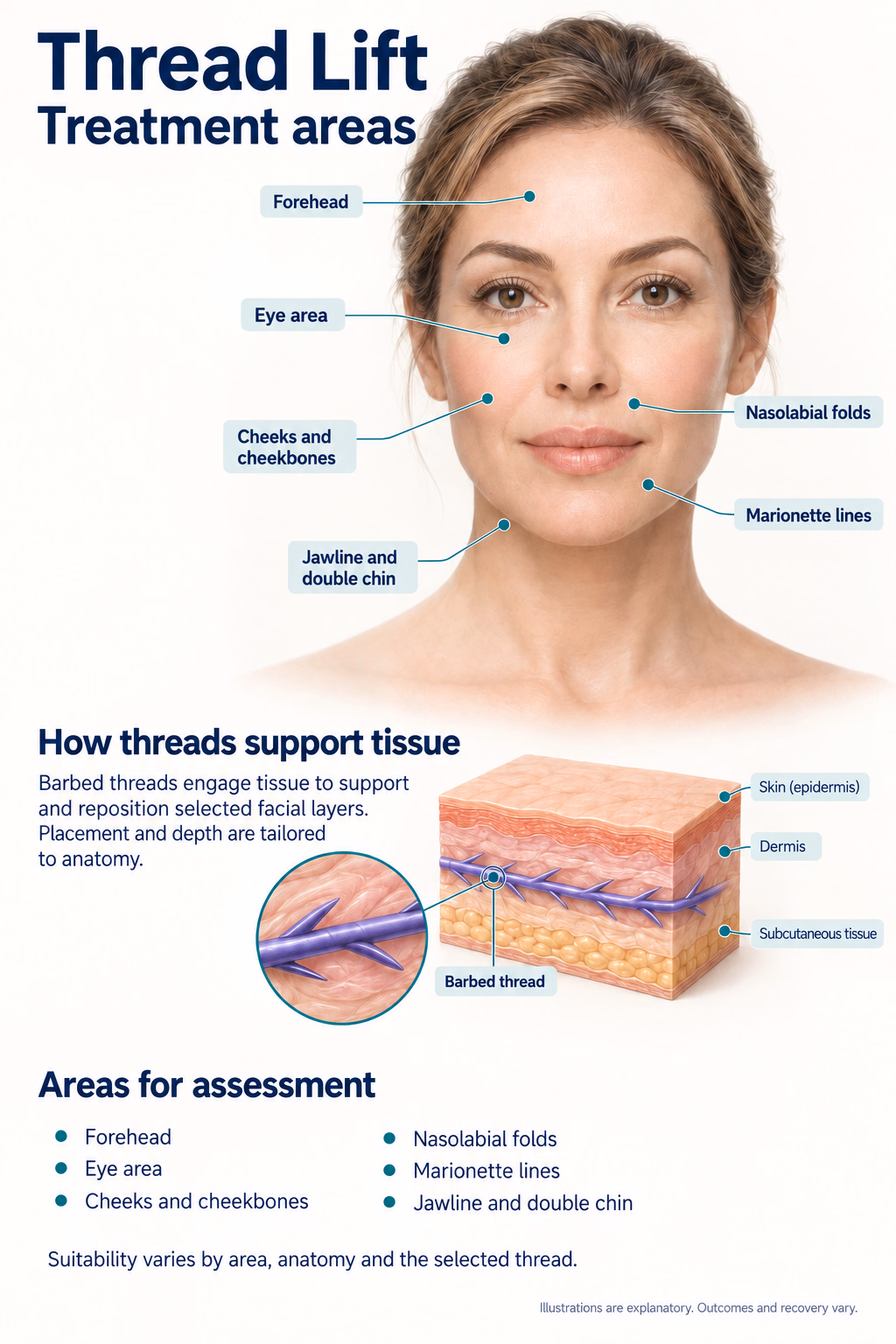 Thread Lift
Treatment areas
How threads support tissue
Barbed threads engage tissue to support and reposition selected facial layers. Placement and depth are tailored to anatomy.
Areas for assessment
Forehead
Eye area
Cheeks and cheekbones
Nasolabial folds
Marionette lines
Jawline and double chin
Suitability varies by area, anatomy and the selected thread.
Diagram labels: Skin (epidermis); Dermis; Subcutaneous tissue; Barbed thread.
Illustrations are explanatory. Outcomes and recovery vary.