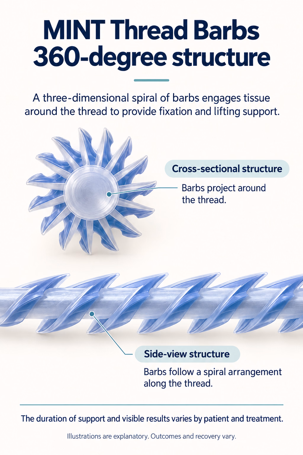 MINT Thread Barbs
360-degree structure
A three-dimensional spiral of barbs engages tissue around the thread to provide fixation and lifting support.
Cross-sectional structure
Barbs project around the thread.
Side-view structure
Barbs follow a spiral arrangement along the thread.
The duration of support and visible results varies by patient and treatment.
Illustrations are explanatory. Outcomes and recovery vary.