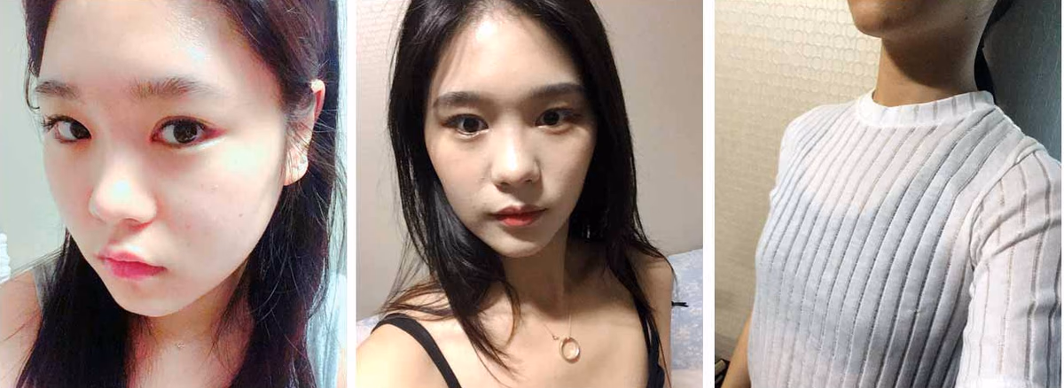 Suji — Before surgery