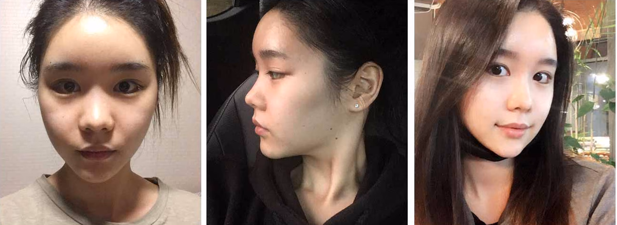 Suji — 2 weeks after surgery