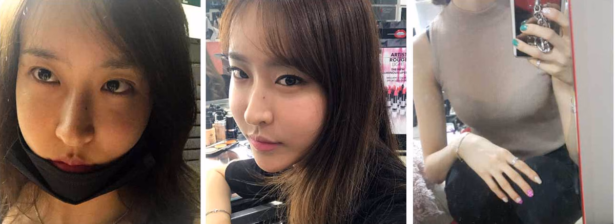 Haneul — ก่อนผ่าตัด