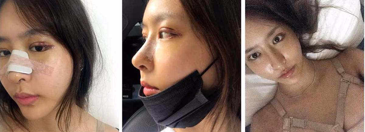 Haneul — หลังผ่าตัด 2 สัปดาห์