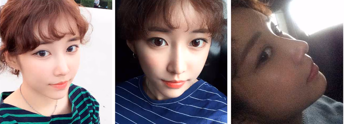 Sunmi — 2 weeks after surgery