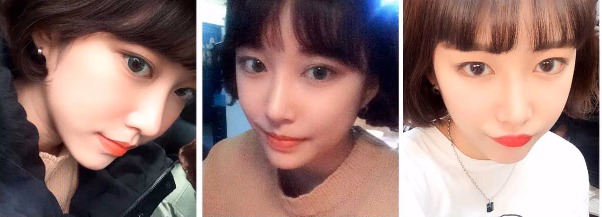 Sunmi — 2 months after surgery