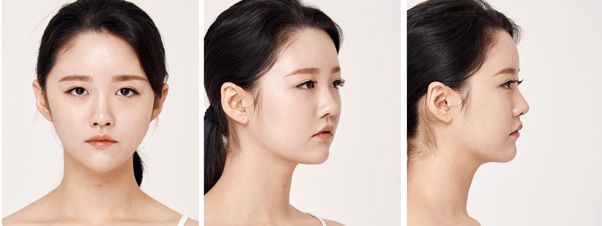 Yoona — 3 months after surgery