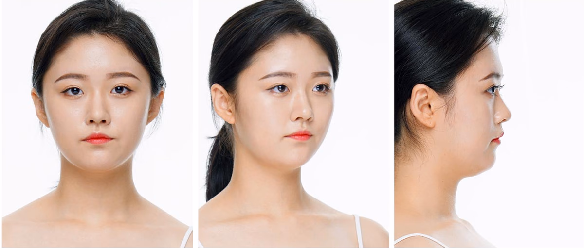Yoona — Before surgery
