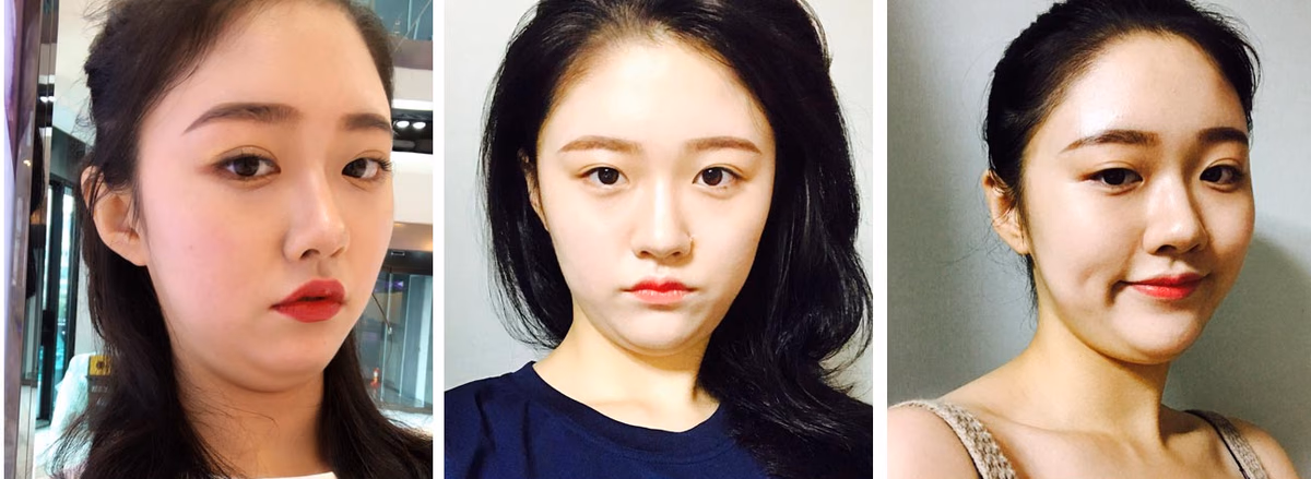 Yoona — Before surgery