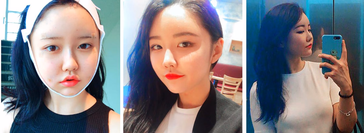 Yoona — 2 weeks after surgery