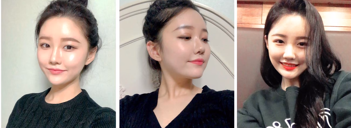 Yoona — 2 months after surgery