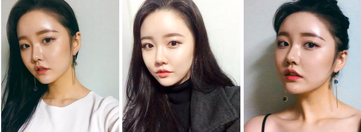 Yoona — 4 months after surgery
