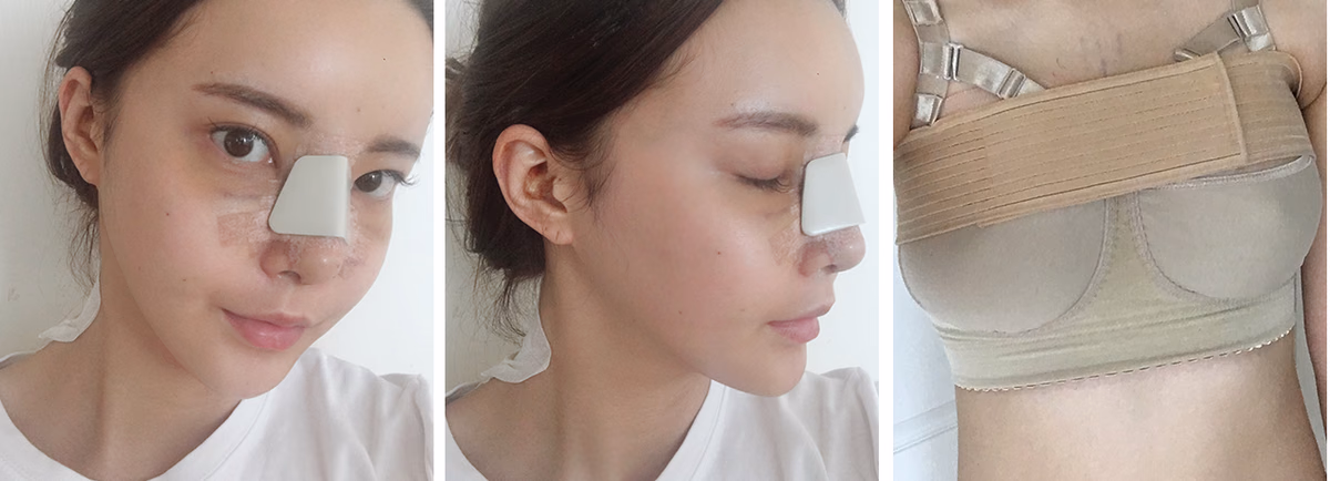 Cheonga — หลังผ่าตัด 2 สัปดาห์