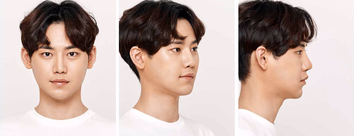 Eunwoo — 3 months after surgery
