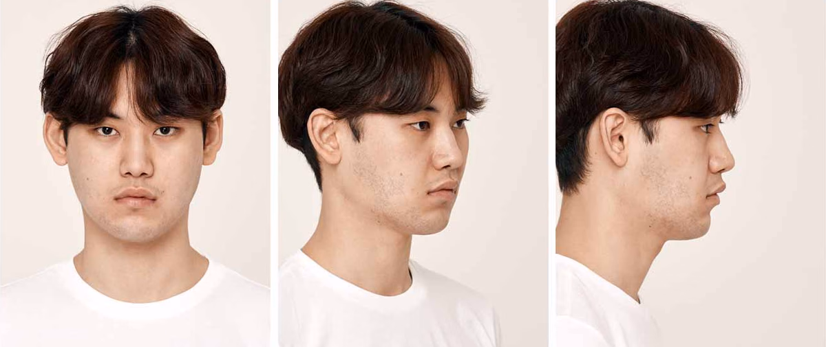 Eunwoo — Before surgery