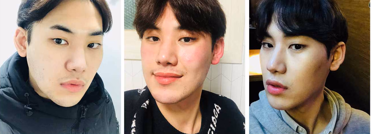 Eunwoo — Before surgery