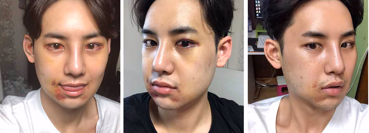 Eunwoo — 2 weeks after surgery