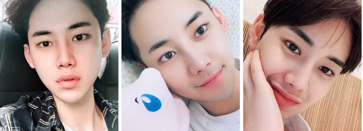 Eunwoo — 6 months after surgery