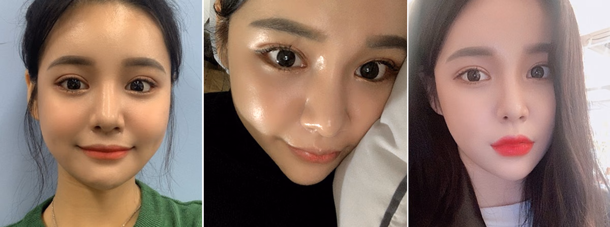 Saebyeok — 3 weeks after surgery
