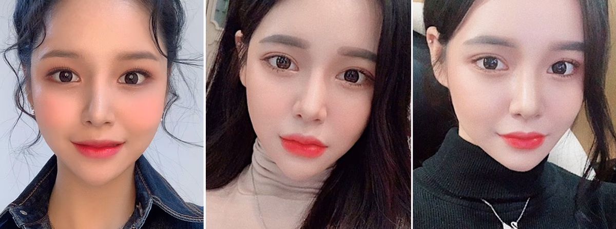Saebyeok — 2 months after surgery