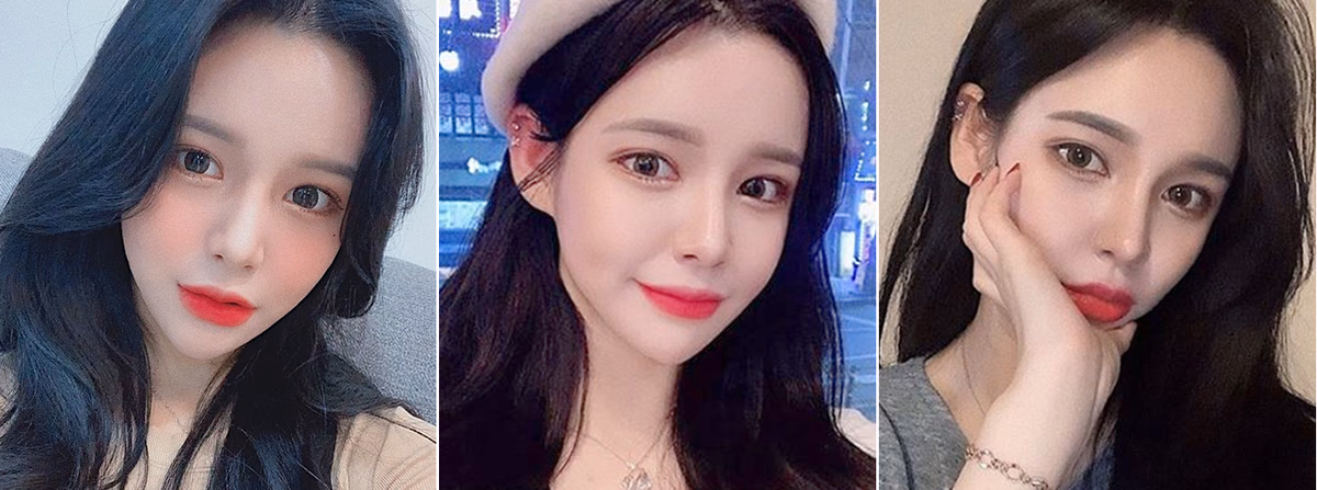 Saebyeok — 3 months after surgery
