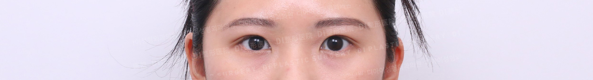 Ptosis Correction · After