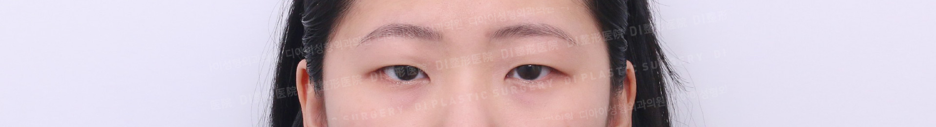Ptosis Correction · Before